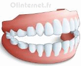 Dentier Prothese dentaire amovible